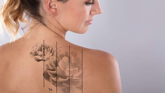 Is Tattoo Laser Removal The Right Choice?