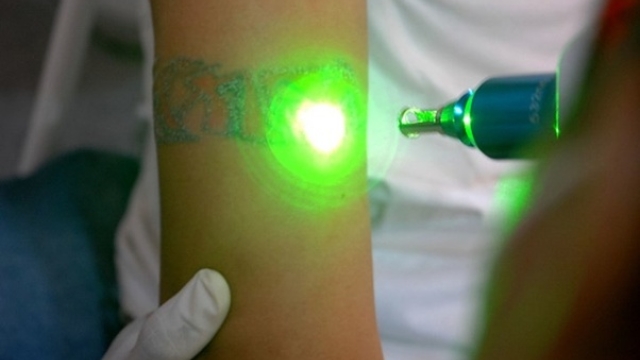 Laser – The New Technology For Tattoo Ridding!