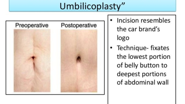 Rock Your Flat Tummy: Unveiling the Magic of Abdominoplasty