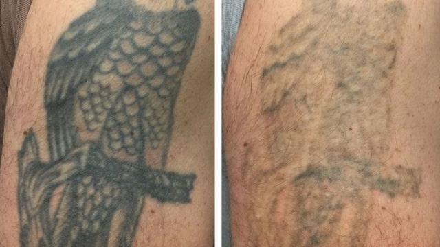 Tattoo Removal – Sources Of Your Unwanted Tattoo