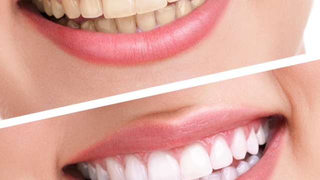 7 Secrets to a Dazzling Smile: Unveiling the Power of Teeth Whitening